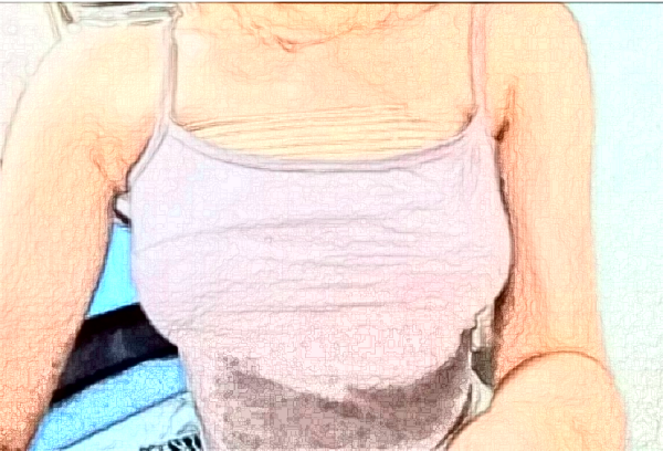 南通假體隆胸價格表?隆胸哪個醫(yī)生好