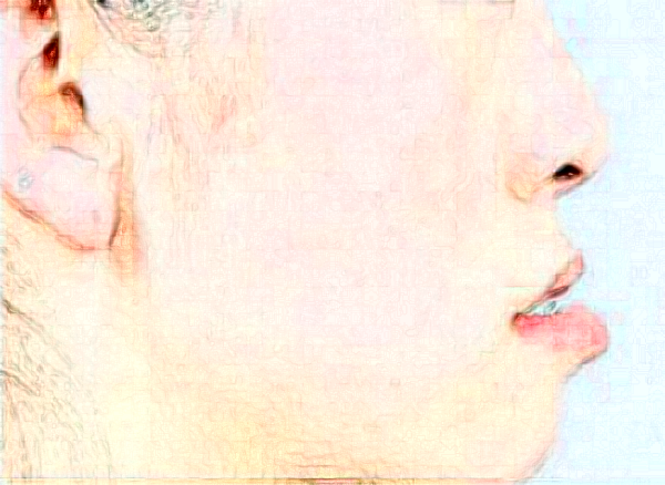 懷化地包天矯正多少錢?地包天矯正醫(yī)生排名