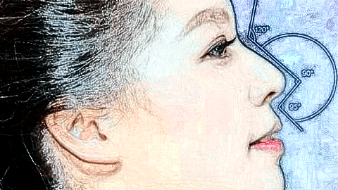 鼻翼縮小價格表_鼻翼縮小術(shù)后還會反彈嗎