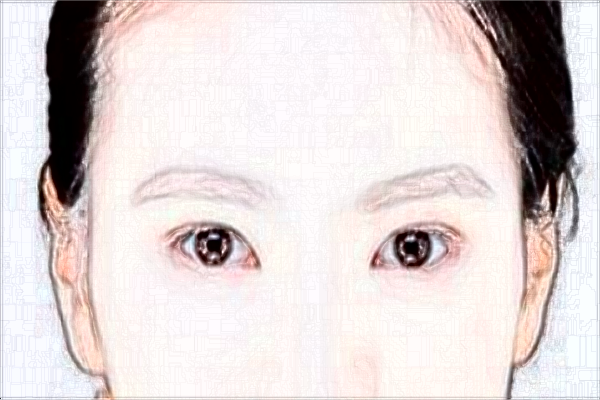 割雙眼皮是全麻還是局部麻醉?割雙眼皮是*的嗎?