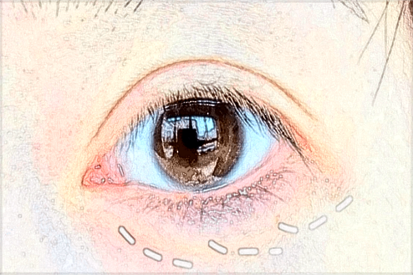 2024上海伯思立去眼袋價(jià)目表(價(jià)格表)新出爐