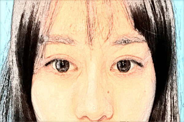 割雙眼皮幾天拆線佳?割雙眼皮幾天可以熱敷?