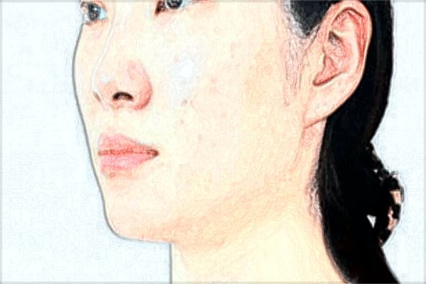 耳垂矯正價(jià)格表_垂耳矯正后還會垂下來嗎