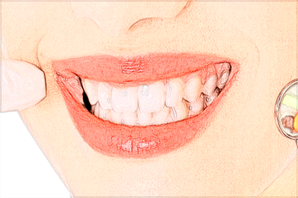 種植牙齒多少錢一顆_2024種植牙價(jià)目表