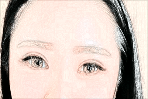 割雙眼皮做哪種比較好?割雙眼皮做提肌和不做的區(qū)別?