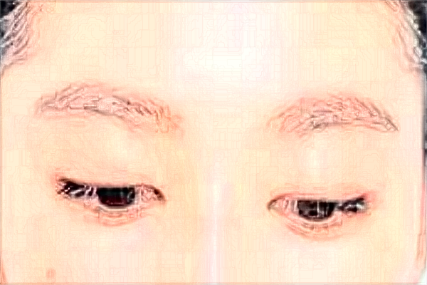 割雙眼皮會(huì)留疤痕不?割雙眼皮會(huì)導(dǎo)致視力下降嗎?