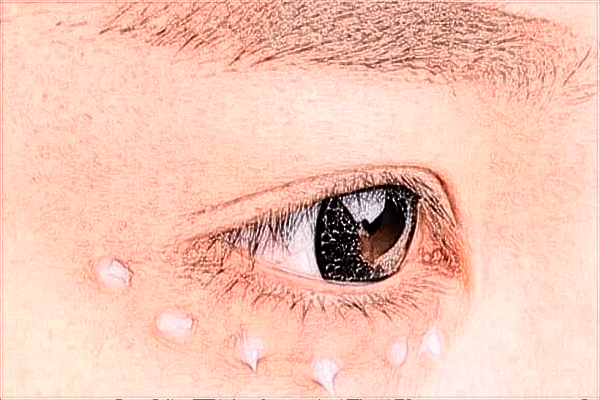 2024北京同仁醫(yī)院去眼袋價格表(價目表)搶先看