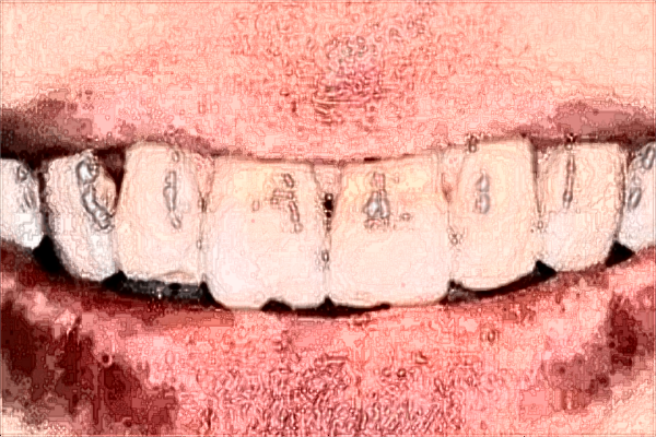 北京同仁醫(yī)院種植牙的技術(shù)好嗎?種植牙的利弊