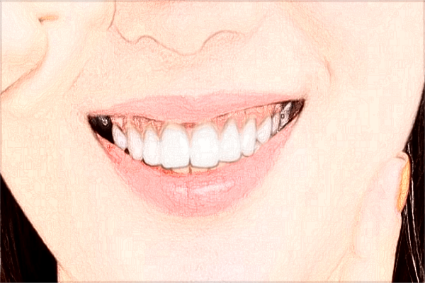 2024義烏牙齒矯正價目表_牙齒矯正的步驟和流程