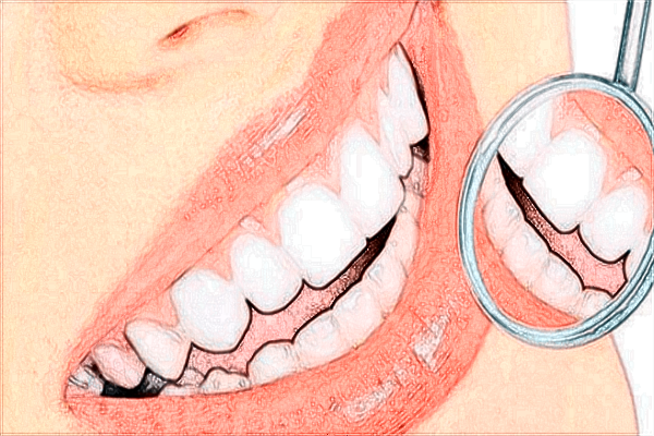 2024煙臺(tái)洛神種植牙價(jià)目表_種植牙是什么材料做的