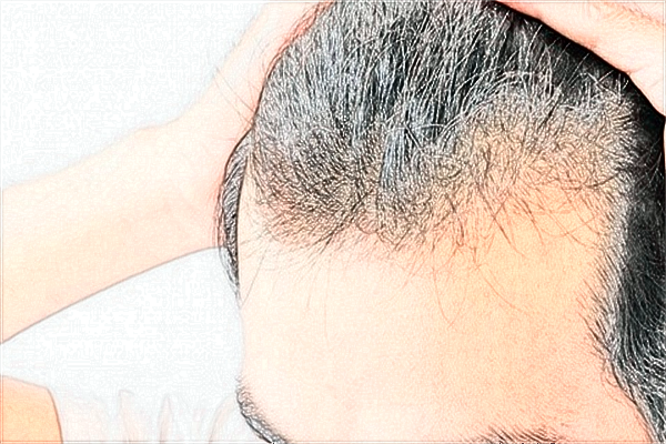 四川米蘭柏羽植發(fā)好不好?2024收費價格表