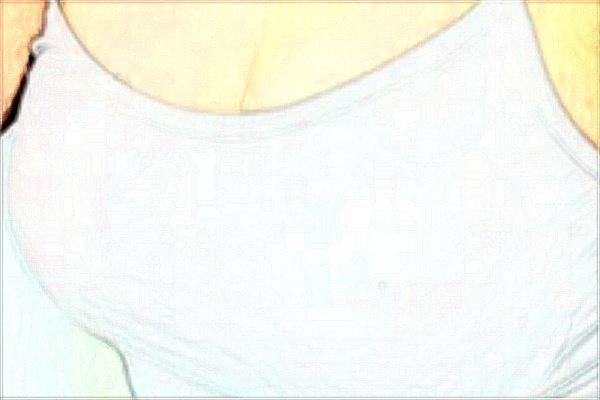 北京協(xié)和醫(yī)院隆胸技術(shù)如何【隆胸案例】