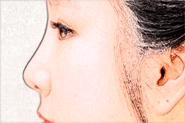 鷹鉤鼻整形怎么樣?鷹鉤鼻整形價(jià)格表一覽