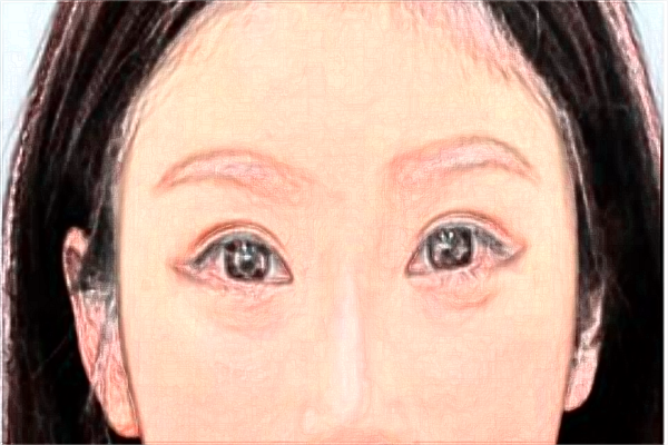 2024沈陽二院眼瞼松弛怎么樣_眼瞼松弛下垂解決方法