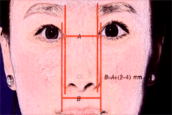 長(zhǎng)沙梵童醫(yī)院熱瑪吉價(jià)格表?熱瑪吉功效與副作用