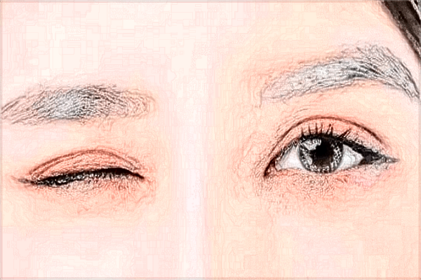 長沙梵童整形醫(yī)院怎么樣?附割雙眼皮案例