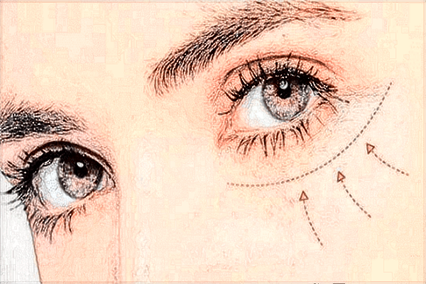 激光近視手術(shù)價(jià)格2024?激光近視手術(shù)的后遺癥有哪些