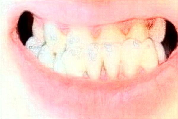 2024北京大學第三醫(yī)院矯正牙齒價格怎么樣