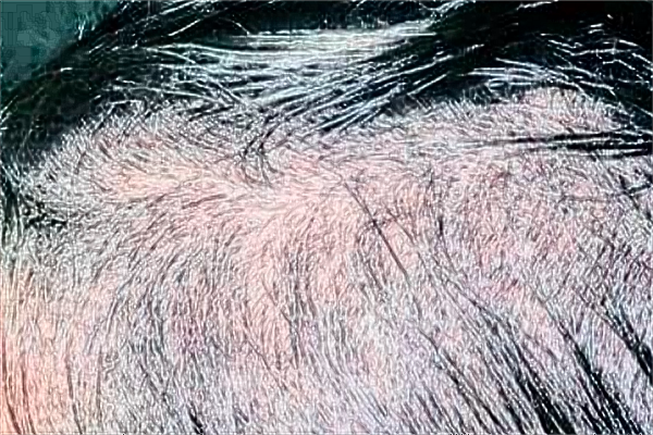 常熟二院植發(fā)好不好?2024植發(fā)價格表