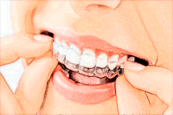 北京大學(xué)口腔醫(yī)院種植牙價(jià)格表_種植牙需要住院嗎