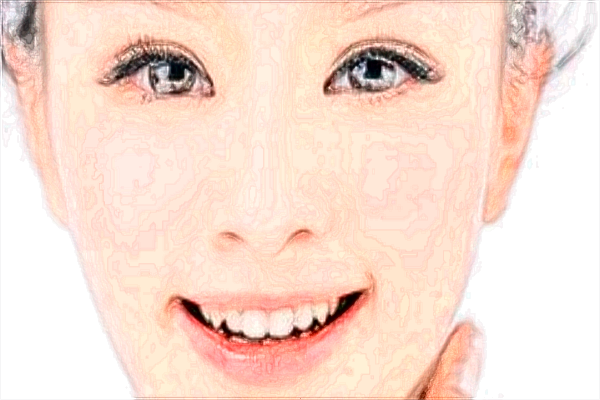 玻尿酸豐面頰幾天好看?玻尿酸豐面頰要做多久?