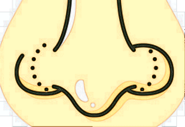 膨體隆鼻會透光嗎?膨體隆鼻會膨體下滑嗎?