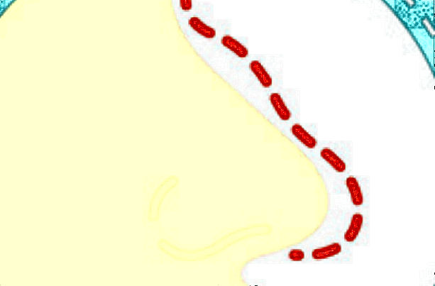 膨體隆鼻多少費(fèi)用?膨體隆鼻要忌口多長時(shí)間?