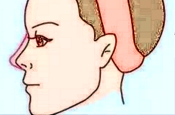 膨體隆鼻需要麻醉嗎?膨體隆鼻需要全麻嗎?