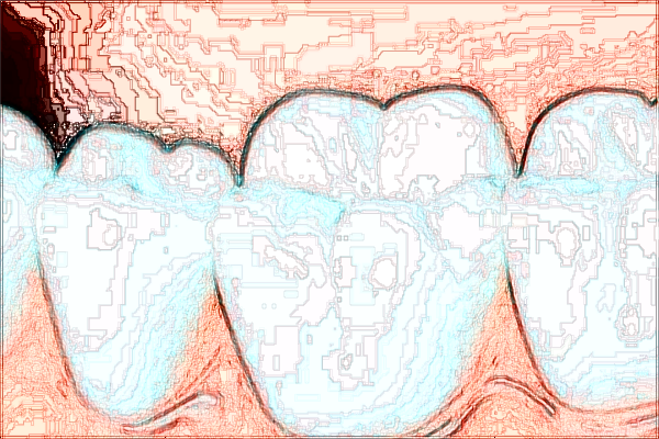 四川省人民醫(yī)院種牙多少錢_種牙和鑲牙區(qū)別在哪里