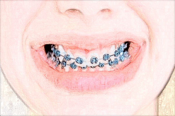 2024四川省人民醫(yī)院口腔科補(bǔ)牙多少錢_價(jià)格表+案例