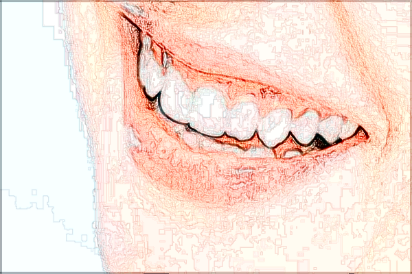 四川省人民醫(yī)院拔智齒多少錢(qián)【拔智齒案例】