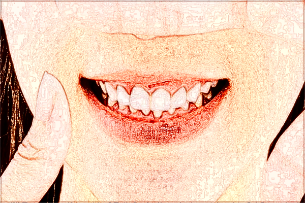 四川省人民醫(yī)院拔智齒多少錢(qián)【拔智齒案例】