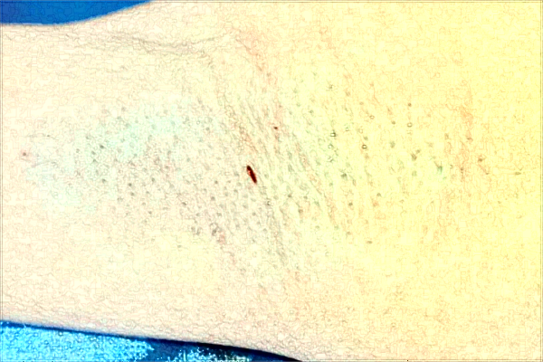 南京市中醫(yī)院激光狐臭做的好嗎？需要多少錢