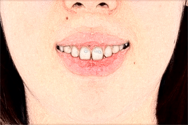 2024福建醫(yī)科大學(xué)附屬協(xié)和醫(yī)院補(bǔ)牙價(jià)格公布