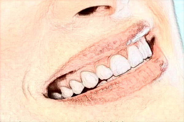 四川省人民醫(yī)院種植牙廖娟技術怎么樣【種植牙案例】