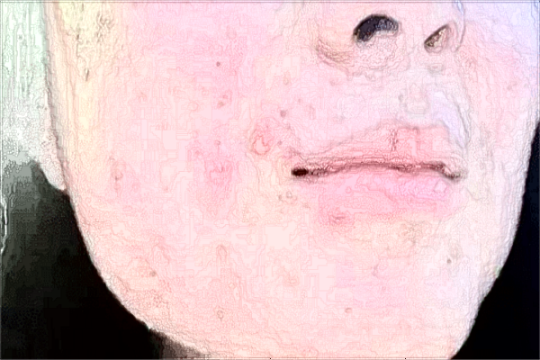 漳州175醫(yī)院祛疤怎么樣?2024祛疤手術(shù)大概需要多少錢(qián)