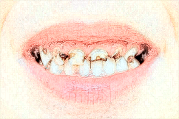 廈門市第—醫(yī)院牙科種植牙找哪個(gè)醫(yī)生?2024收費(fèi)價(jià)格