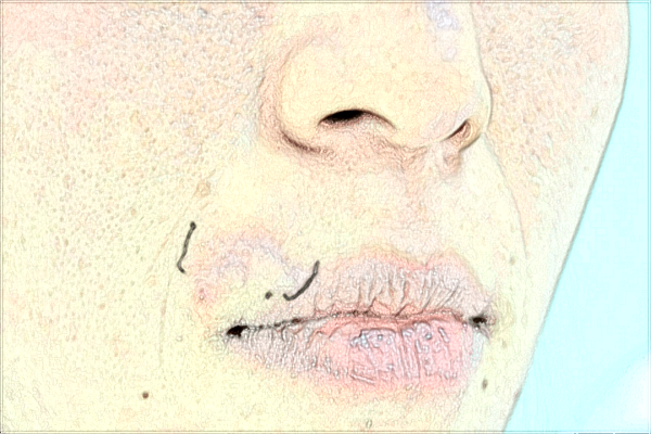 河科大二附院祛痘印怎么樣?去痘印新價格2024