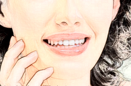 北京大學第一醫(yī)院熱拉提做的好嗎【熱拉提案例】