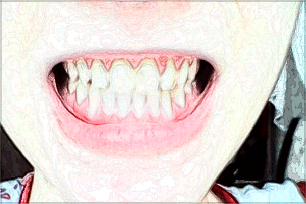 北京大學人民醫(yī)院種植牙怎樣_哪個醫(yī)生做得好