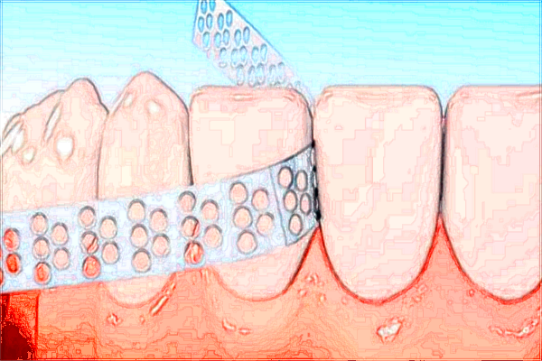 北大口腔醫(yī)院植牙一般需要去幾次_醫(yī)院技術(shù)怎么樣