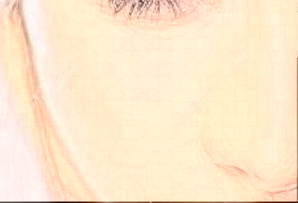 2024-2024河北醫(yī)科大學(xué)第一醫(yī)祛疤怎么樣_祛疤案例