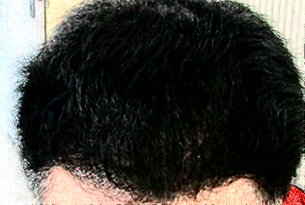 廣州華美植發(fā)靠譜嗎_怎么樣