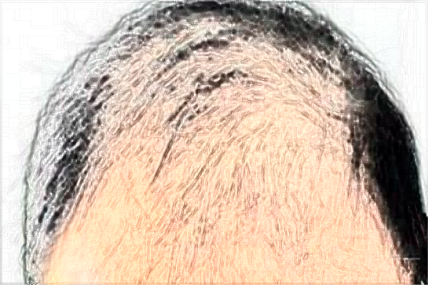 南昌大學(xué)第一附屬醫(yī)院種植頭發(fā)怎么樣?2024植發(fā)價格