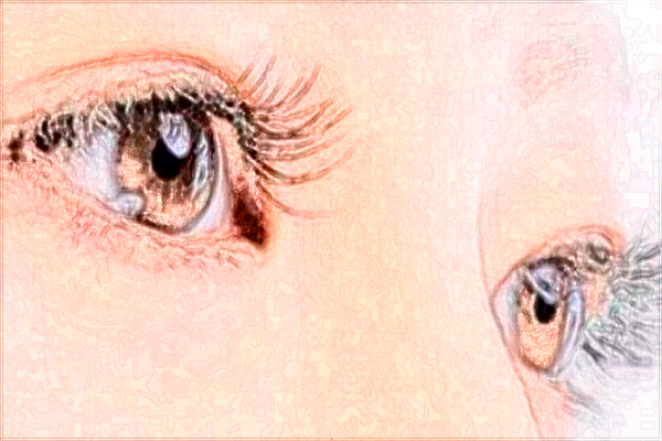 2024四川華西醫(yī)院割雙眼皮價(jià)格多少_做的怎么樣