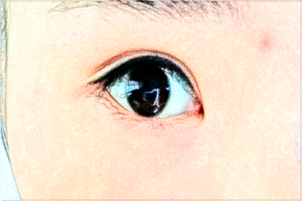 六安市人民醫(yī)院激光去除眼袋有沒(méi)有作用_做的怎么樣