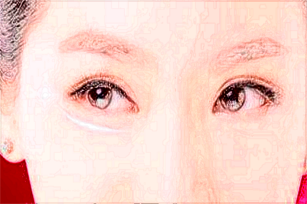 六安市人民醫(yī)院激光去除眼袋有沒(méi)有作用_做的怎么樣