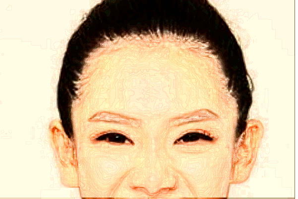 六安市人民醫(yī)院植發(fā)技術怎么樣【植發(fā)案例】