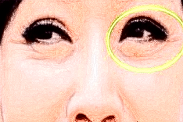 南昌大學第二附屬醫(yī)院激光祛斑怎么樣?激光祛斑的恢復期