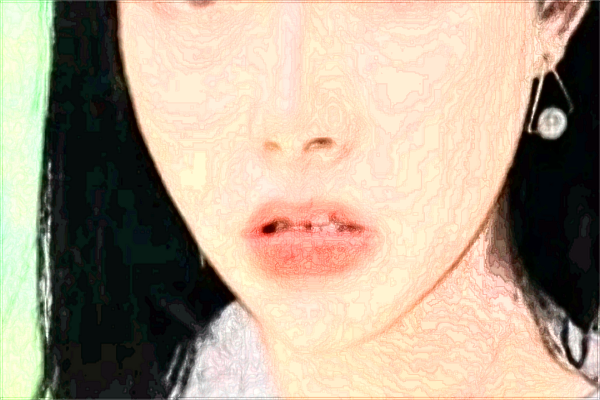 浙江省中醫(yī)院脂肪填充做的好嗎_案例+價(jià)格